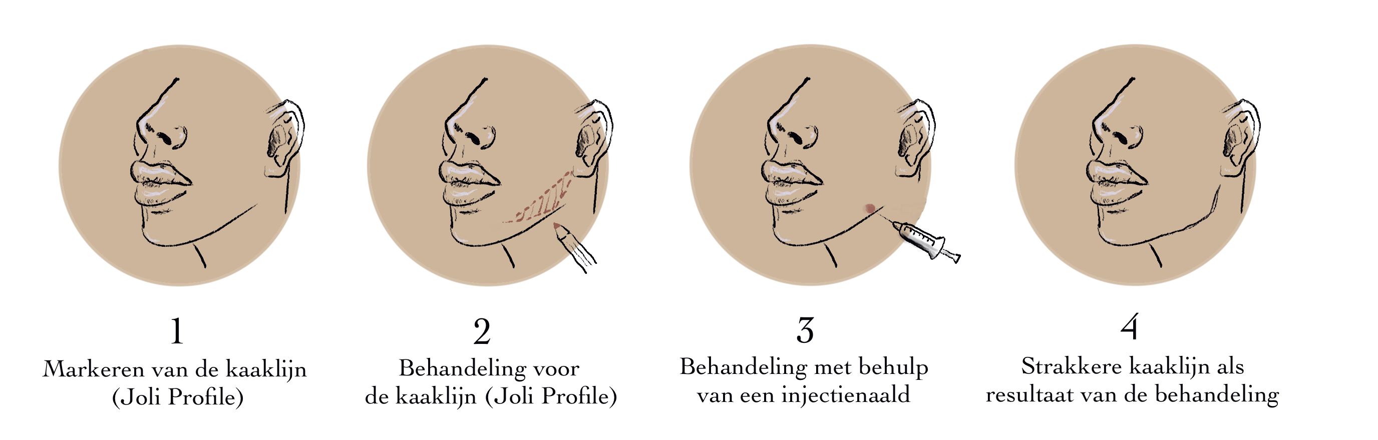 Kaaklijn fillers