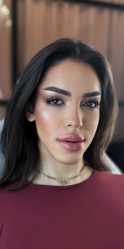 Lip fillers after