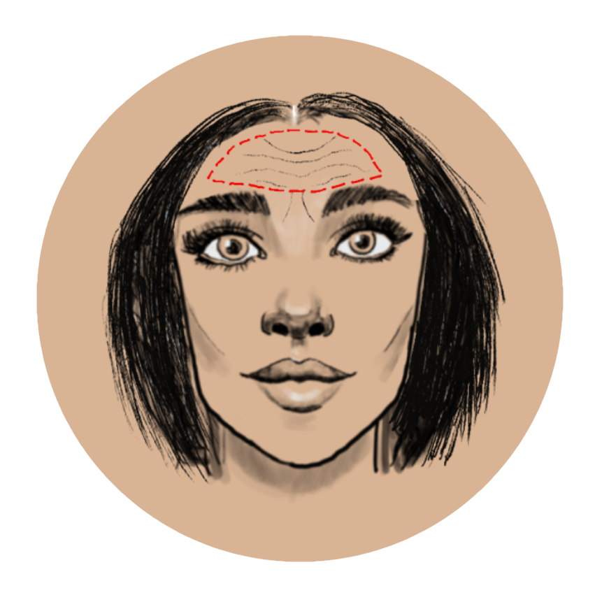 Botox Voorhoofd Behandeling